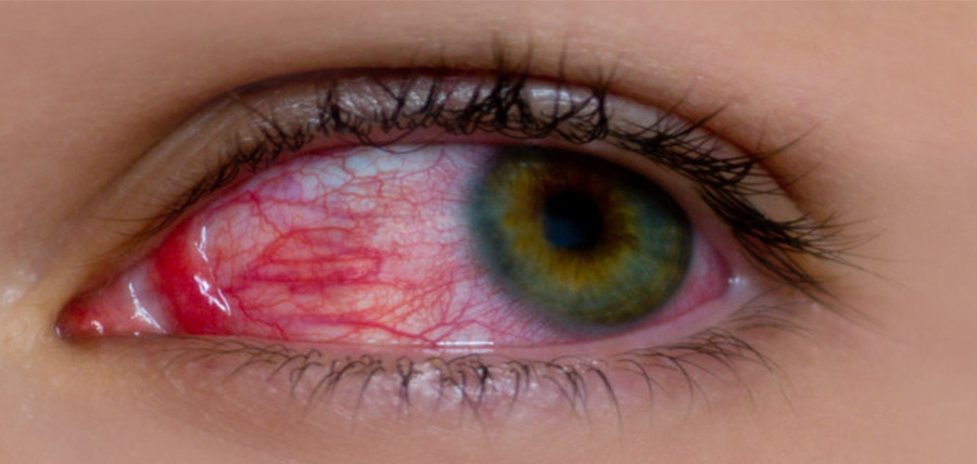 Αίμα στο μάτι από σπασμένα αιμοφόρα αγγεία, Υπόσφαγμα article cover image