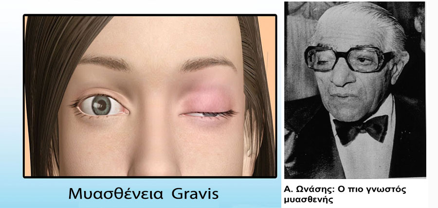 Μυασθένεια Gravis με βλεφαρόπτωση, κόπωση, μυϊκή αδυναμία article cover image