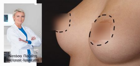 Υποδόρια μαστεκτομή διατήρησης θηλής (Nipple – sparing mastectomy) cover image