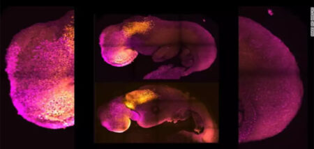 Ελπίδα μέσα από την τραγωδία: Έμβρυο που έχασε 2 αδέρφια από θανατηφόρα γενετική ασθένεια, γιατρεύτηκε μέσα στη μήτρα cover image
