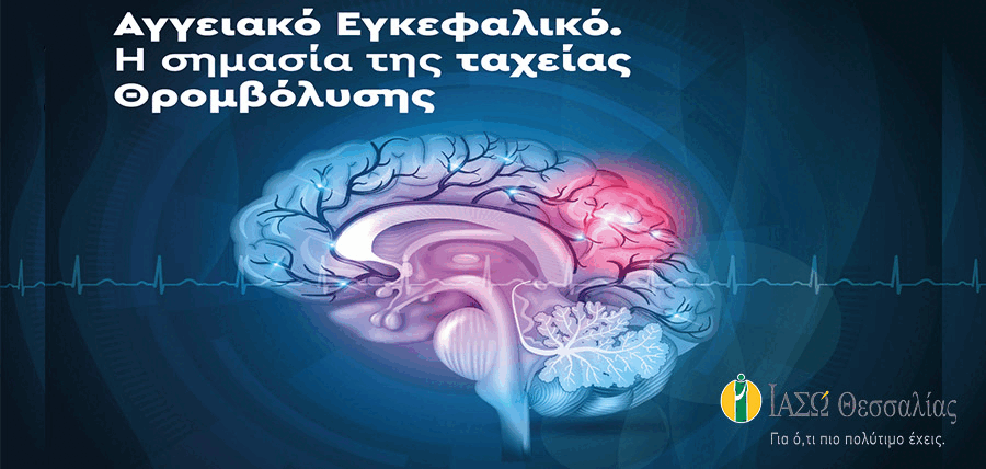 Αγγειακό Εγκεφαλικό Επεισόδιο. Η σημασία της ταχείας θρομβόλυσης  cover image